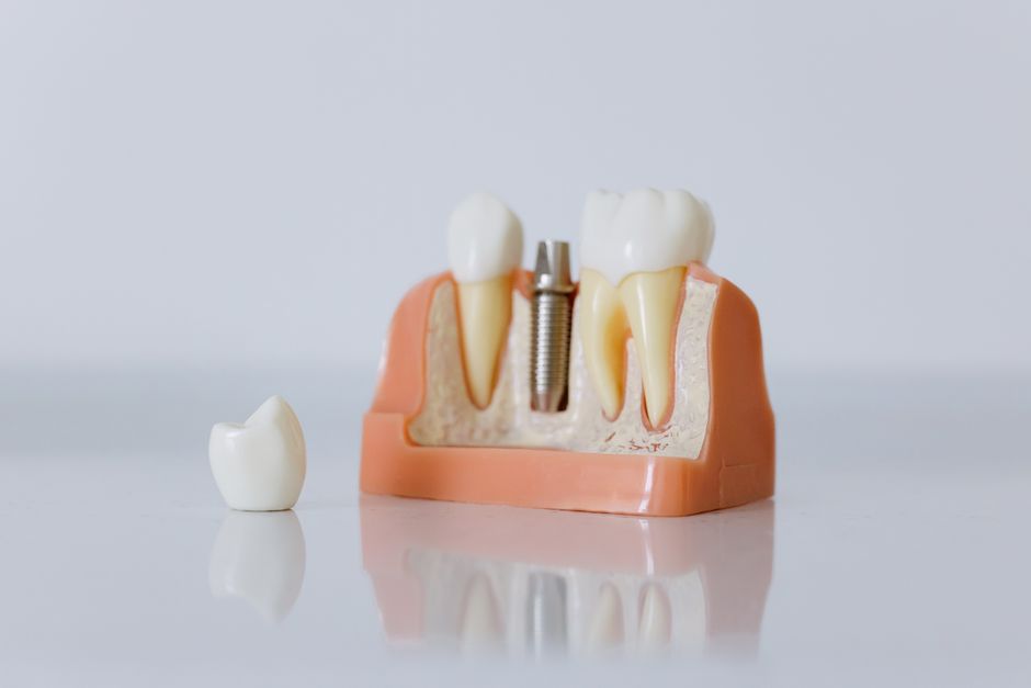 Cutaway dental model showing a titanium implant in the jaw beside two natural teeth, with a loose crown on the table